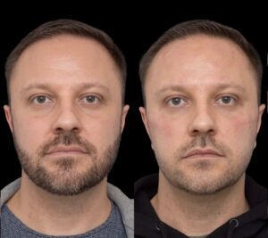 under eye fillers