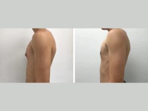 gynecomastia in dubai