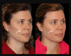 Sculptra Fillers Treatments in Dubai