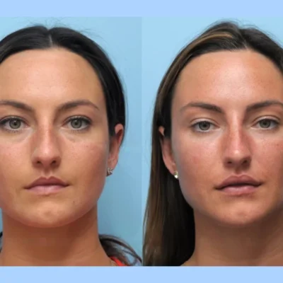 Dubai’s Best Doctors for Thread Lift: A Client-Centered Experience