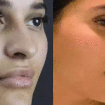 nose surgery in dubai