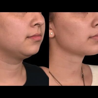 Double chin removal