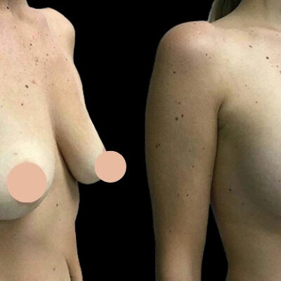 Breast Augmentation in Dubai