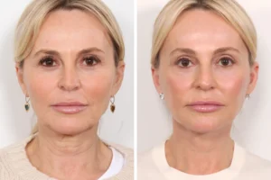 Expert Best Plastic Surgeons in Dubai: Thread Lifts & Facelifts