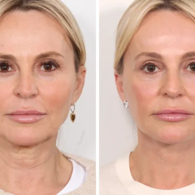 Expert Best Plastic Surgeons in Dubai: Thread Lifts & Facelifts