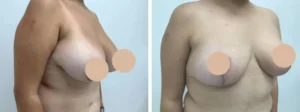 breast lift in dubai