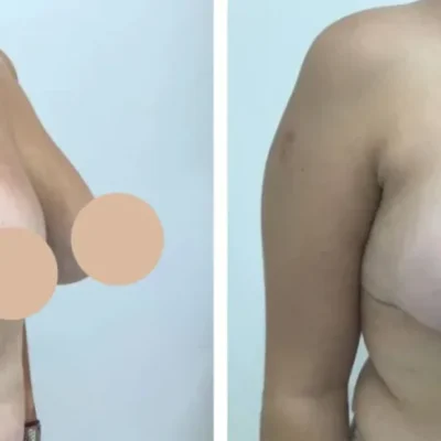 breast lift in dubai