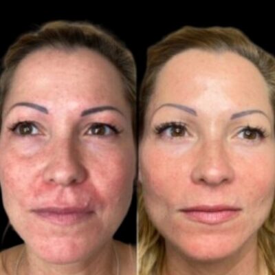 Profhilo treatment in dubai
