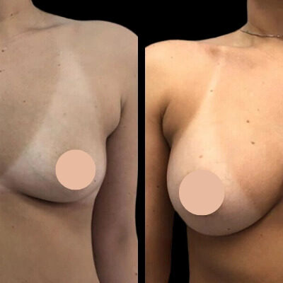 Top 5 Reasons to Choose Breast Augmentation in Dubai