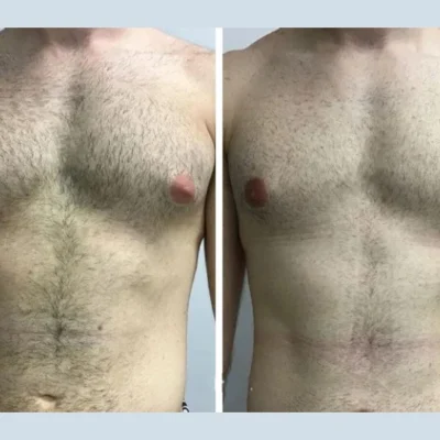 What to Expect from Gynecomastia Surgery in Dubai: A Complete Guide