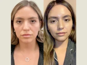 The Best Time of Year to Book Your Thread Lift Treatment in Dubai

