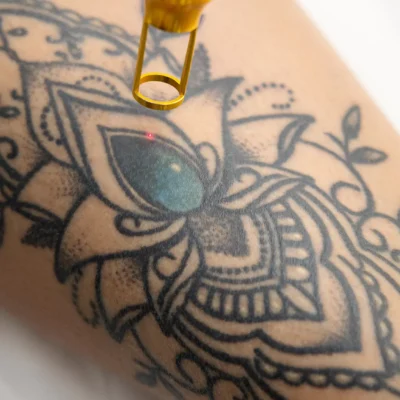 Laser tattoo removal in Dubai