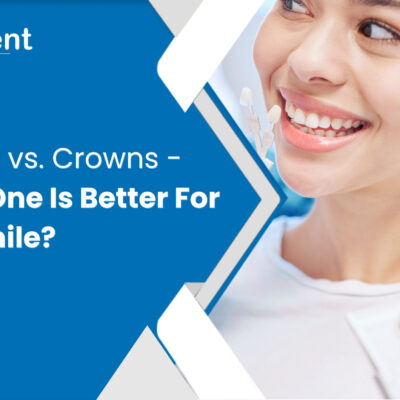 Veneers vs. Crowns - Which One Is Better For Your Smile