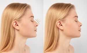 rhinoplasty Dubai