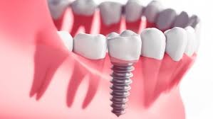 Affordable and Long-Lasting Single Tooth Implants in Tampa