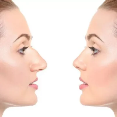 rhinoplasty Dubai