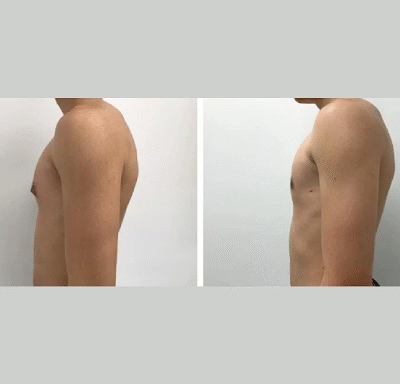 Gynecomastia surgery