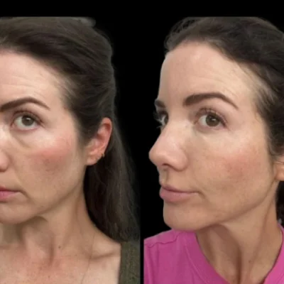 dark circles treatment in dubai