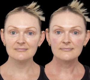 Under-eye-fillers