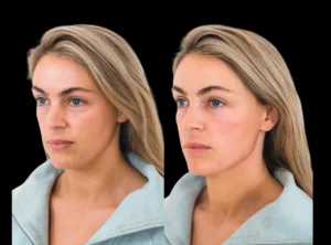 Cheek-Fillers in Dubai