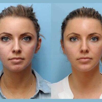 Age Gracefully with Thread Lift Treatments in Dubai