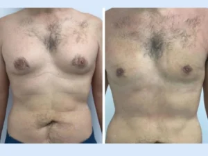 Gynecomastia in Dubai,