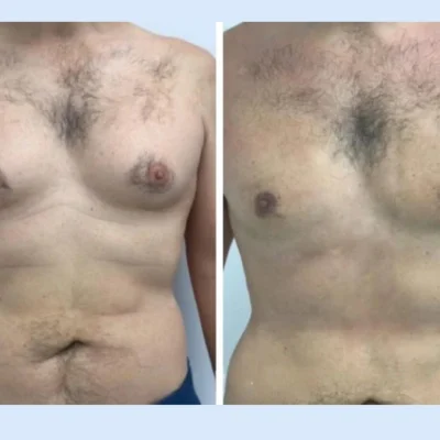 Gynecomastia in Dubai,
