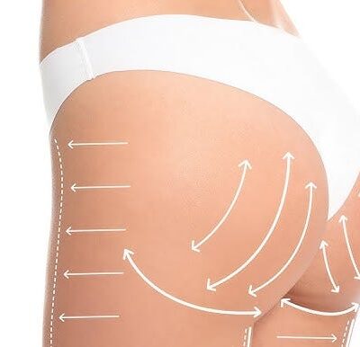 Butt Fat Transfer in dubai