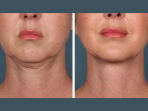 PRP Treatment in Dubai