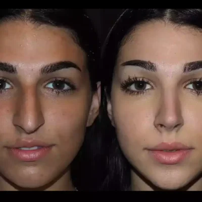 Septoplasty in Dubai