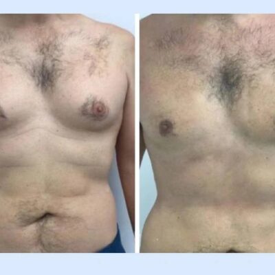 gynecomastia in dubai