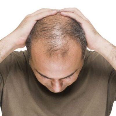 hair transplant in Dubai (2)