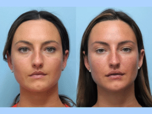 Best Doctors in Dubai for Thread Lift – FAQs Answered