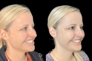 How Safe is Botox Treatment in Dubai?