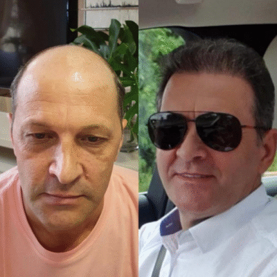 hair transplant uk