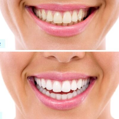 teeth whitening price
