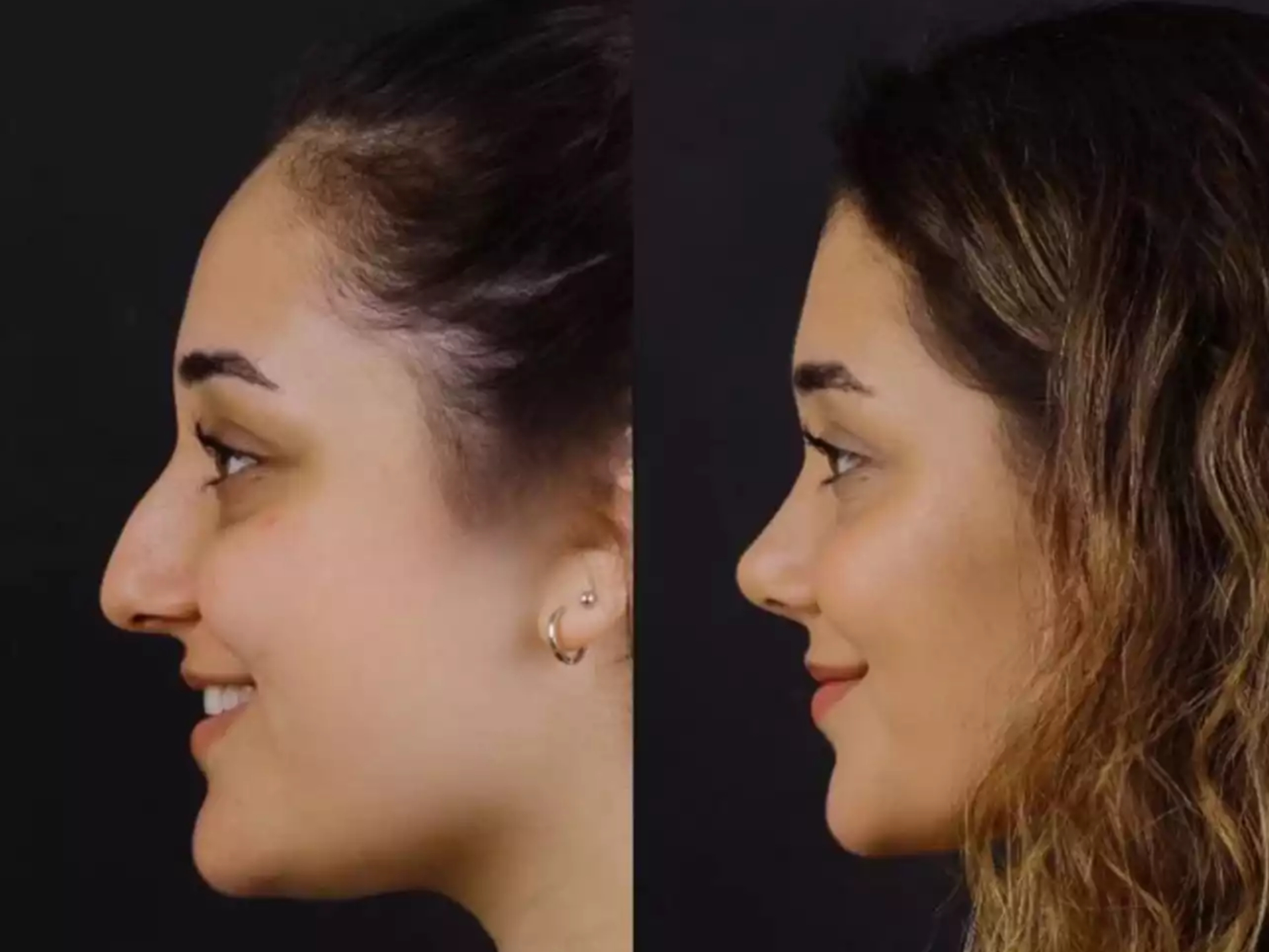 Evaluation Criteria Used to Select the Best Doctors in Dubai for Septoplasty