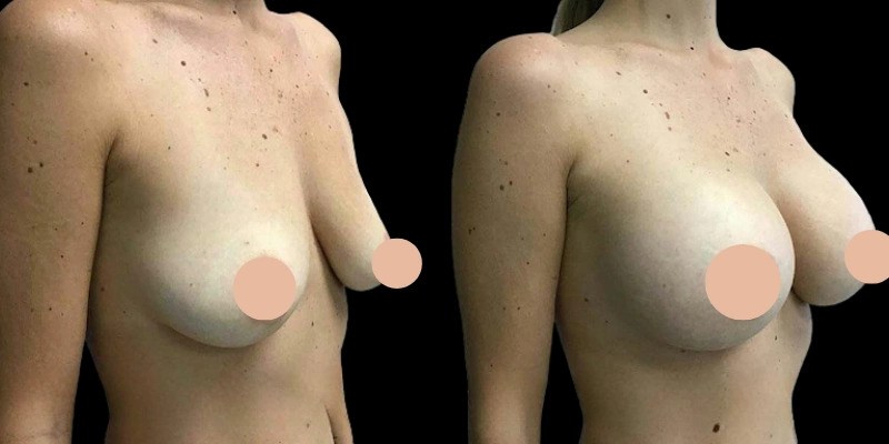 Legal and Health Regulations Around Breast Augmentation in Dubai