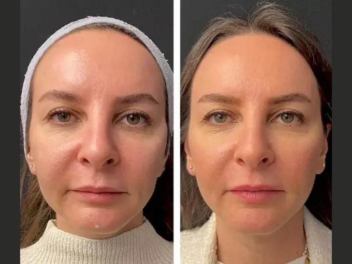 Mesotherapy Treatment in Dubai: Men’s Skin Revitalization