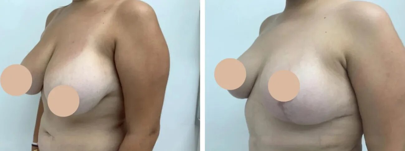 Breast Lift in Dubai Expert Surgeons Share Insights