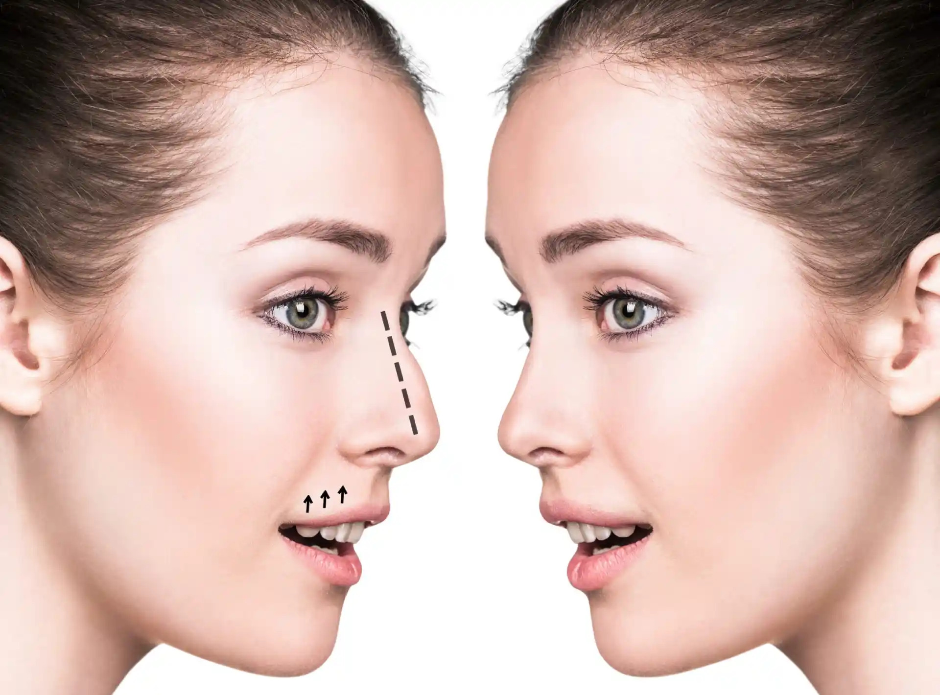 Skill Indicators of the Best Doctors in Dubai Performing Rhinoplasty