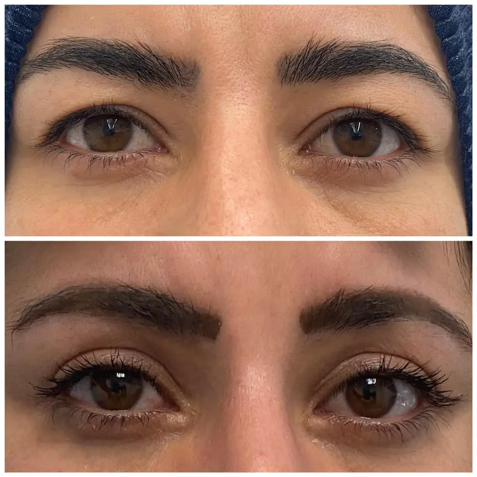 Eye Bag Removal