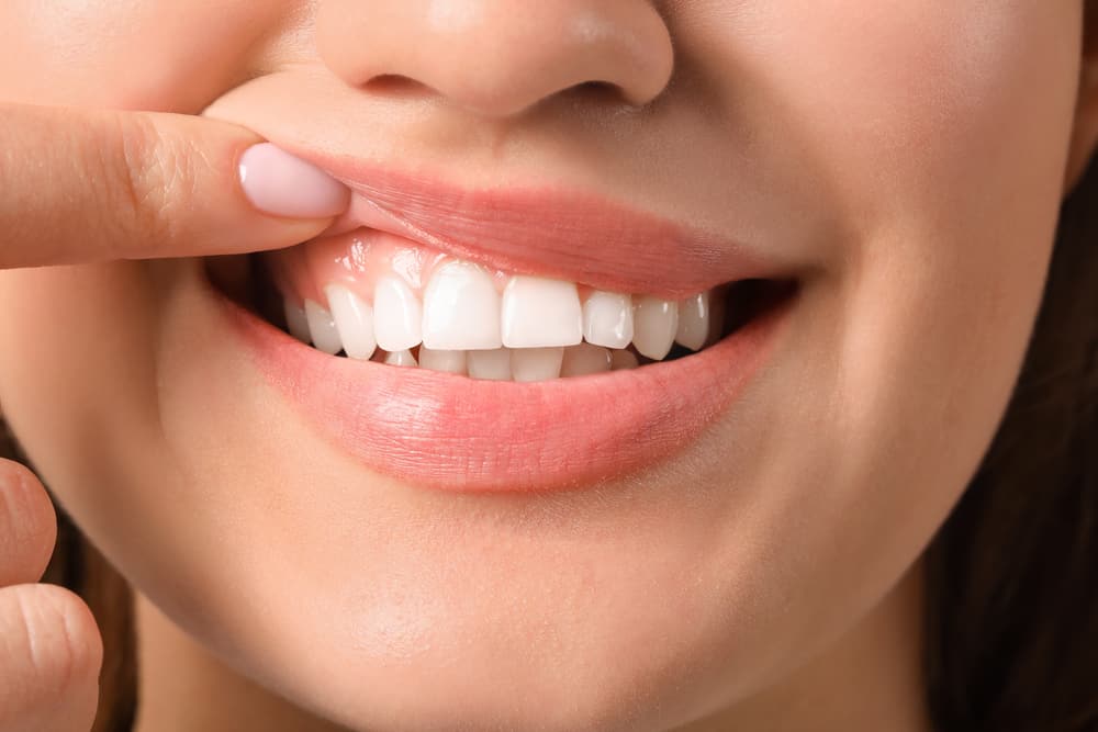 Mouth Dental Implants