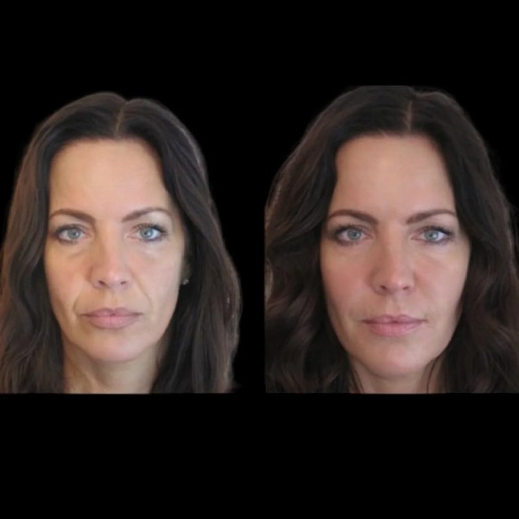 Jawline Fillers: The Advantages of Non-Surgical Jaw Contouring with Best Doctors in Dubai