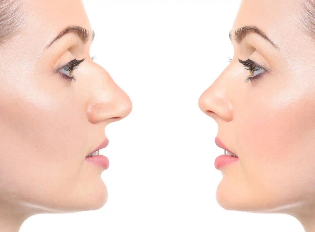 Best Doctors in Dubai for Rhinoplasty: Transforming Faces with Expertise