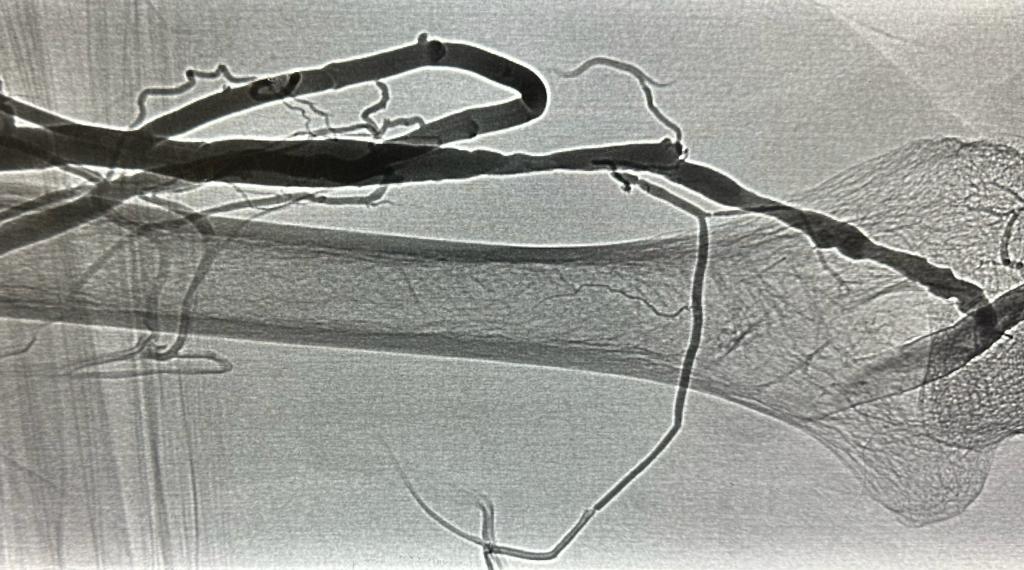 Arteriovenous Singapore