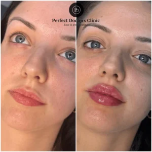 Fillers Treatment in Dubai: Non-Surgical Beauty at Its Best