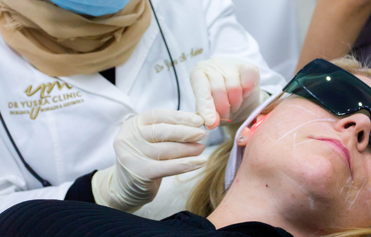 Endolift laser treatments