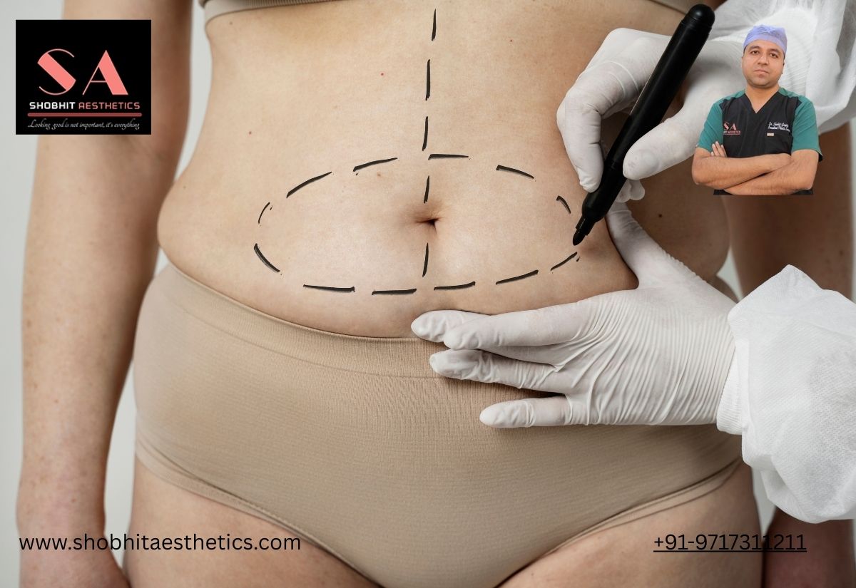 Liposuction Surgery in Delhi: What You Should Know — A Deep Dive
