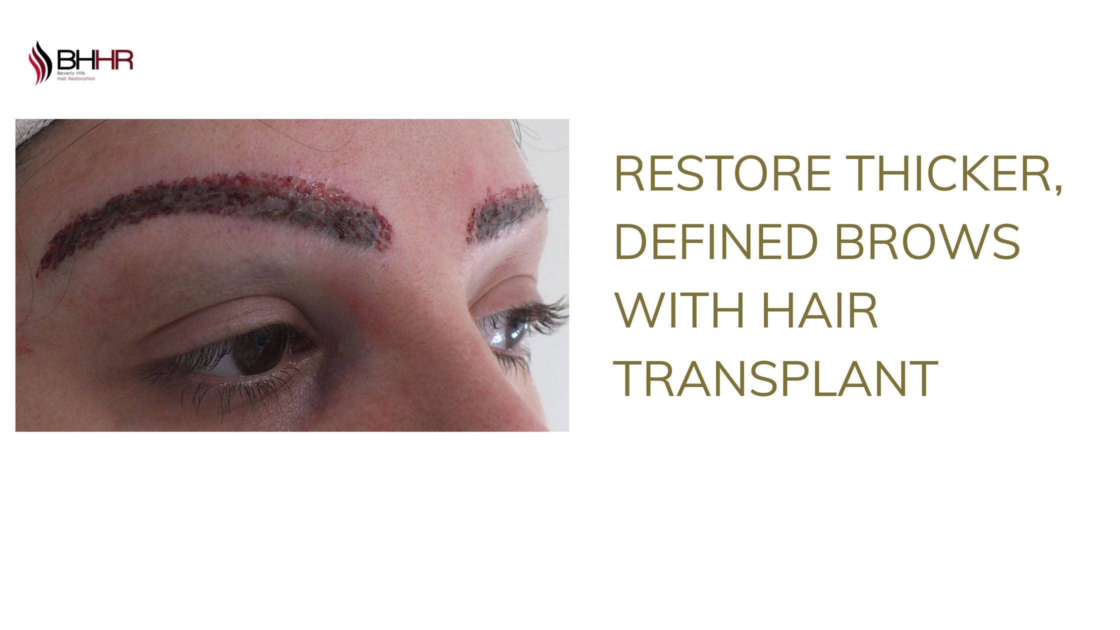 hair transplant for eyebrows